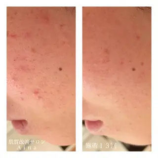 セミロング カラー パーマ ヘアアレンジ メンズ キッズ ネイル マツエク・マツパ ニキビ跡専門サロン Ainaのエステ・リラクイメージ