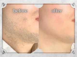 都度払い 脱毛 Lino柏/moeのエステ・リラクイメージ