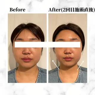 12Dハイフ💗 最強小顔のエステ・リラクイメージ