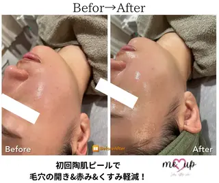 Meupニキビ専門店 背中/ハーブ/肌管理のその他イメージ