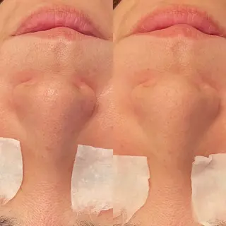 毛穴ケア/毛穴診断/ 毛穴洗浄〔心斎橋〕のエステ・リラクイメージ