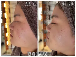 安心の看護師施術 ニキビ改善HAONのエステ・リラクイメージ