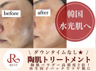 毛穴・ニキビケア　ハーブピーリング【肌管理専門店】WHITE AQUA鳳店所属・ホワイトアクア 鳳店のエステ・リラクイメージ