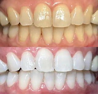 io teeth careのその他イメージ