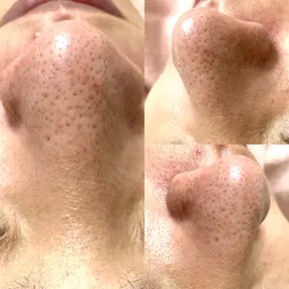 韓国式３D毛穴洗浄＆ 脱毛vive京橋のエステ・リラクイメージ