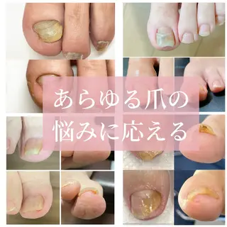 ネイル 深爪・巻き爪 専門サンセリテのネイルデザイン