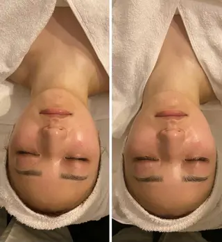 毛穴/ピーリング ララピール/POLAのエステ・リラクイメージ