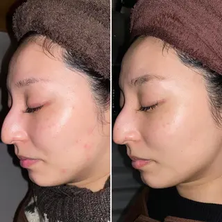 即小顔♥️美容鍼× ハーブピーリングのその他イメージ