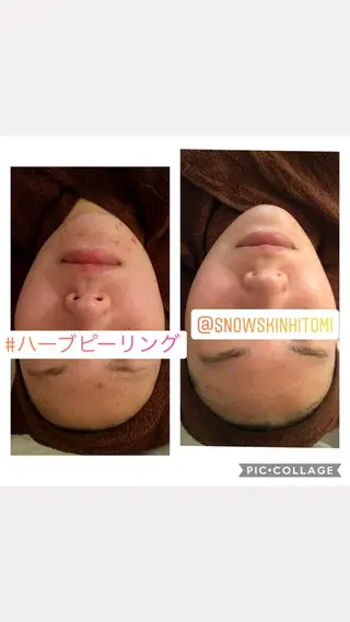 ニキビ/肌質改善専門 Snow skinのエステ・リラクイメージ