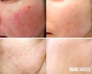 顔脱毛＆毛穴＆ニキビ 優良№1♪ヒロコ♪のエステ・リラクイメージ