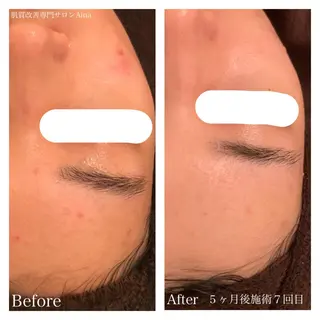 ミディアム カラー キッズ ネイル マツエク・マツパ ニキビ跡専門サロン Ａｉｎａのエステ・リラクイメージ