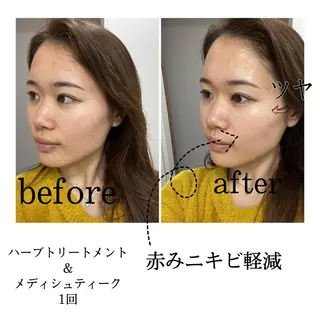 marron所属・痩身ハイパーナイフ ララピールリアボーテのエステ・リラクイメージ