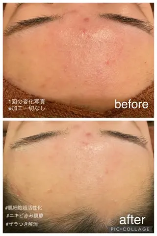 夏までに肌荒れ卒業 するサロン🌻のエステ・リラクイメージ