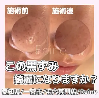 Reine BeautySalon所属・毛穴/シミ肝斑/脱毛 横山梨里のエステ・リラクイメージ
