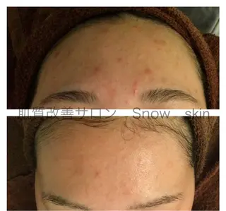 ニキビ/肌質改善専門 Snow skinのエステ・リラクイメージ