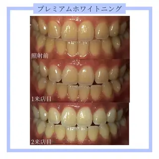ホワイトニング｜韓国式3D毛穴洗浄 lonhana ﾛﾝﾊﾅ所属・韓国式3D毛穴洗浄 lonhanaのその他イメージ