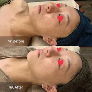 肌改善グリーンピール 東川口/浦和美園のエステ・リラクイメージ