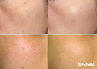 全身脱毛＆VIO脱毛 紹介率№1♪リナ♪のエステ・リラクイメージ