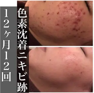 ミディアム カラー パーマ ヘアアレンジ メンズ キッズ ネイル マツエク・マツパ アイブロウ 夏までに肌荒れ卒業 するサロン🌻のエステ・リラクイメージ