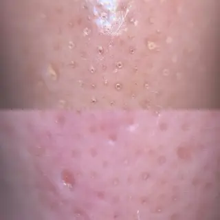 毛穴ケア/毛穴診断/ 毛穴洗浄〔心斎橋〕のエステ・リラクイメージ