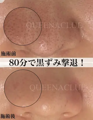 毛穴改善/脱毛 ネイル　川上久仁子のエステ・リラクイメージ