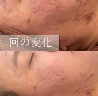 ニキビ特化型エステ 🍓最短で肌質改善のエステ・リラクイメージ