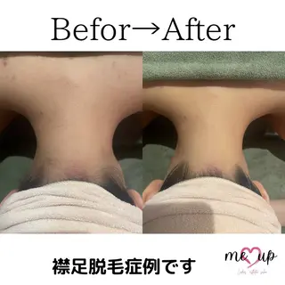 Meupニキビ専門店 背中/ハーブ/肌管理のその他イメージ