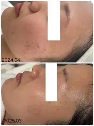 NARIS BEAUTY STATION　デ・アイム あべのルシアス所属・ニキビ跡/毛穴/ 肌質改善/北村ももこのエステ・リラクイメージ