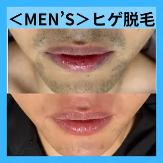 【地域最安値】脱毛/ フェイシャル　山下のエステ・リラクイメージ