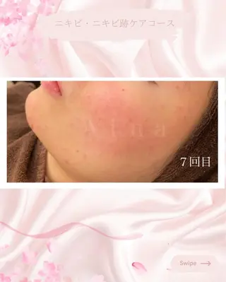 ニキビ跡専門サロン Ａｉｎａのエステ・リラクイメージ