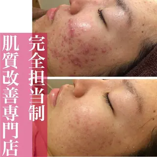 セミロング カラー パーマ ヘアアレンジ メンズ キッズ ネイル マツエク・マツパ アイブロウ 🔥3か月で肌革命 🔥ニキビ専門店のエステ・リラクイメージ