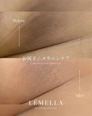 メラニンケアサロンM/é（エムエ）所属・メラニンケア M/é柴田のその他イメージ