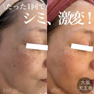 【しみ毛穴専門店】beautysalon Ankh所属・しみ毛穴専門店 Ankh 平田のエステ・リラクイメージ