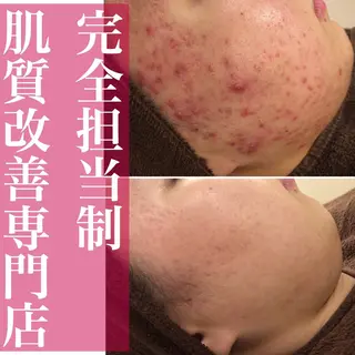 ミディアム パーマ ネイル マツエク・マツパ アイブロウ ニキビ・肌質改善専門 ♡人生が変わるサロンのエステ・リラクイメージ