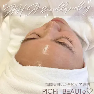 タルミ,ニキビケア専門PICHi BEAUTeピチボーテ所属・トクシゲ マホのエステ・リラクイメージ