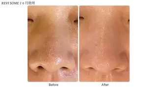 池袋ニキビ毛穴改善 🌿ハーブピーリングのエステ・リラクイメージ