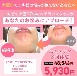 ニキビケア◇ニキビ跡 レゾン京橋店　八崎のエステ・リラクイメージ