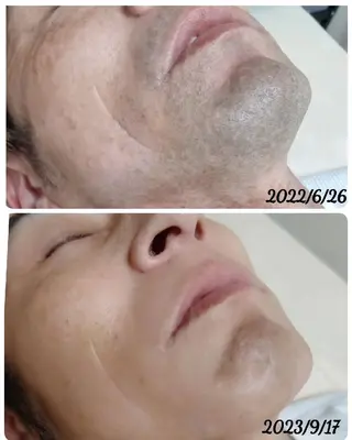 ブラジリアンワックス 脱毛 キナリのエステ・リラクイメージ