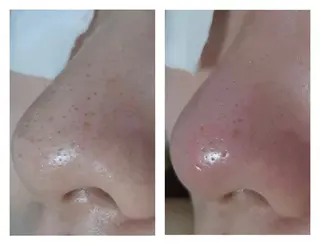 毛穴ケア・肌質改善 徳川のエステ・リラクイメージ