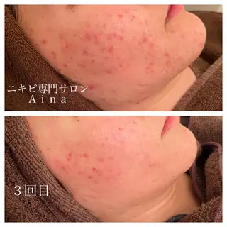 ロング カラー パーマ ヘアアレンジ メンズ キッズ ネイル マツエク・マツパ ニキビ跡専門サロン Ainaのエステ・リラクイメージ