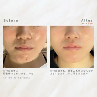 繰り返すニキビ・毛穴 ✨つくば肌質改善専門のエステ・リラクイメージ