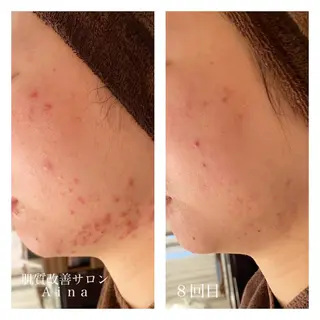 セミロング カラー パーマ ヘアアレンジ メンズ キッズ ネイル マツエク・マツパ ニキビ跡専門サロン Ainaのエステ・リラクイメージ