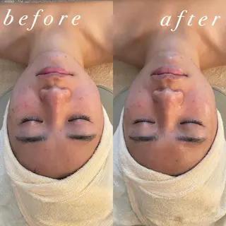 うなじ脱毛/美肌脱毛 LABELのエステ・リラクイメージ