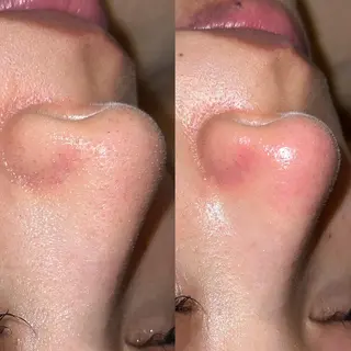 ハーブピーリング /毛穴ケア/脱毛/韓国ツヤ肌専門店【HARU.】所属・韓国ツヤ肌ピーリング ハーブ脱毛HARU.のエステ・リラクイメージ