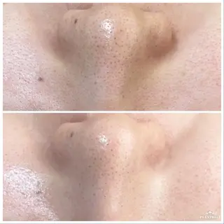 ニキビ・毛穴改善 🌿ハーブピーリングのエステ・リラクイメージ