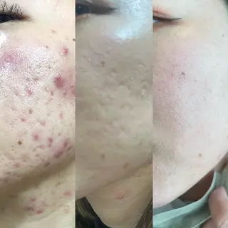 角質・毛穴洗浄🌼 脱毛🌸嶋津弘美のエステ・リラクイメージ