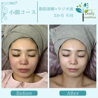 小顔ハーブピーリング 美容鍼/毛穴洗浄のエステ・リラクイメージ