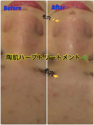 【リベルハーブピーリング認定店】敏感肌・美白脱毛専門店Dione立川店所属・Dione 立川店のエステ・リラクイメージ