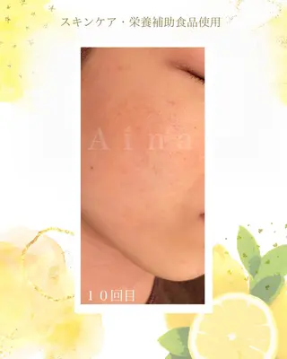 ニキビ跡専門サロン Ａｉｎａのエステ・リラクイメージ