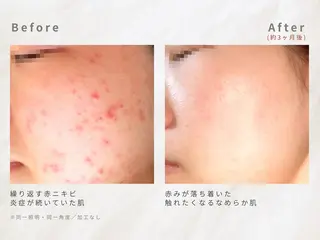 繰り返すニキビを改善 ✨つくば肌質改善専門のエステ・リラクイメージ
